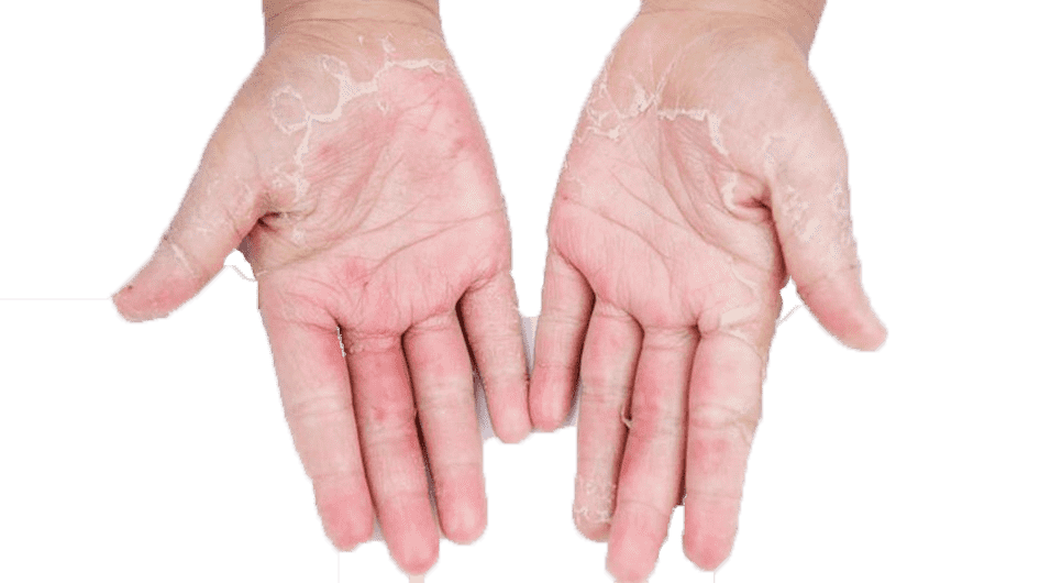 What is latex allergy in adults? – Istanbul Allergy